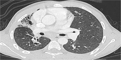 Chronic granulomatous disease in the United Arab Emirates: clinical and molecular characteristics in a single center